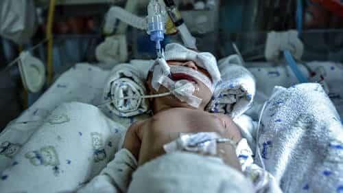meconium aspiration syndrome birth injury lawsuit