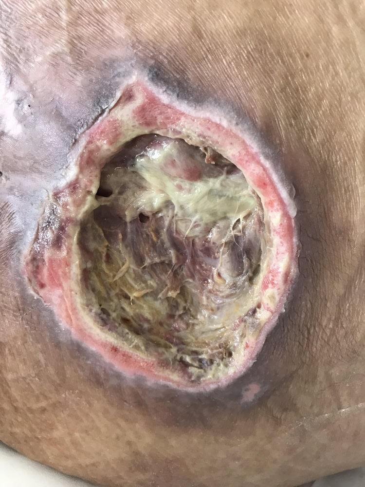 Attorney offering assistance for filing a claim related to bed sores.
 