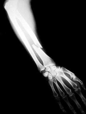 Chicago Broken Bone Injury Lawyer 