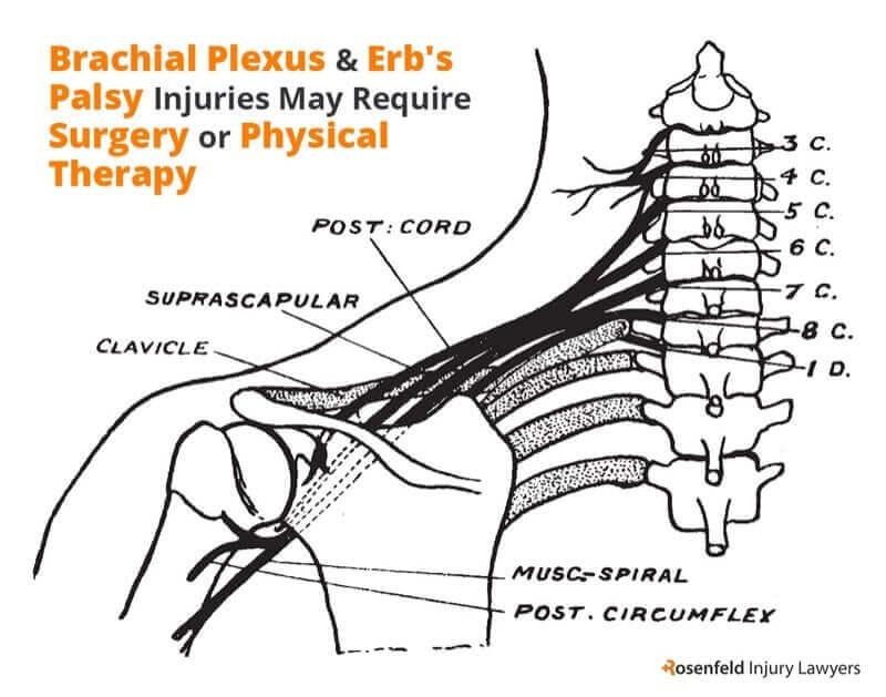 Chicago Erb's Palsy Lawyer