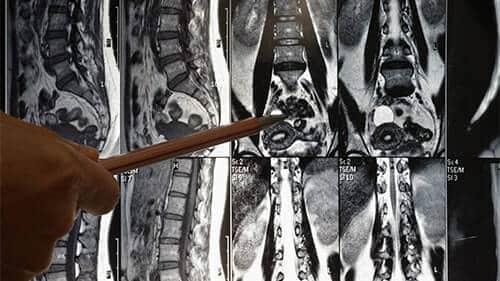 doctor-looking-at-mri-of-spinal-cord-accident-victim-chicago-illinois