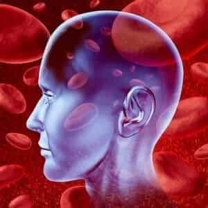 Stroke Misdiagnosis Lawsuit