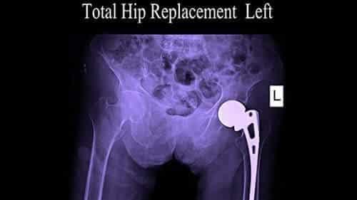 Wright Hip Replacement Lawsuit